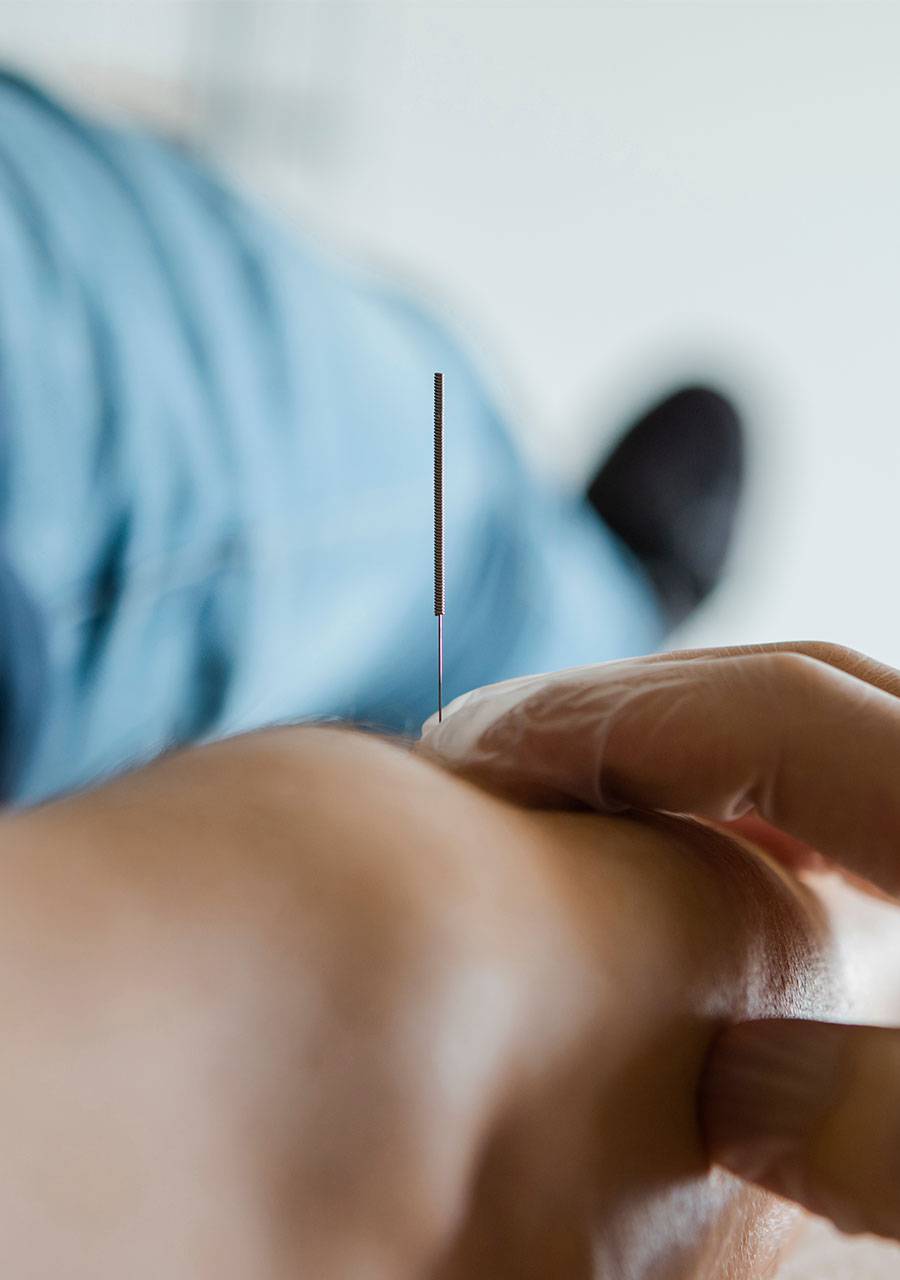 Dry needling treatment